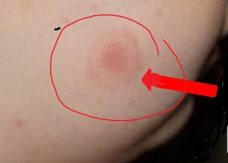 Atenție, părinți și bunici, nu e de glumit! Dr. Tudor Ciuhodaru: Mușcăturile de căpușe pot fi periculoase